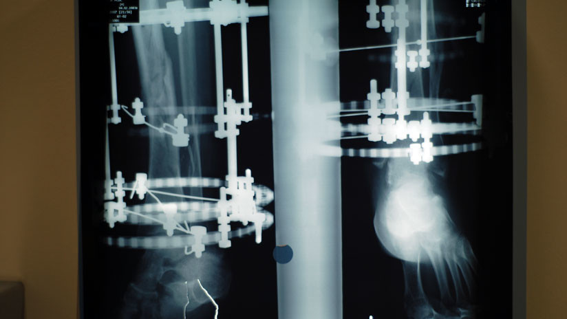 Imagen ilustrativa / Radiografía de pierna con aparato Ilizárov. wikipedia.org / Viapastrengo / CC BY-SA 3.0