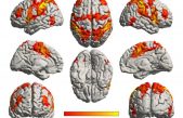 Conservación de la percepción musical en pacientes de Mal de Alzheimer cuando otras funciones se han perdido