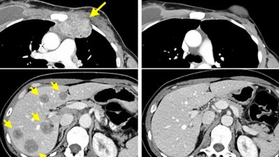 Eliminan el cáncer de mama gracias a las células T de la propia paciente