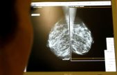 Hallan un método para impedir el cáncer de mama
