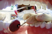 ¿Cirugía dental sin bisturí? Ya es posible