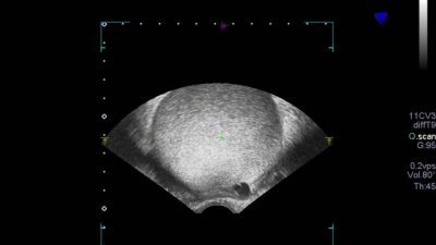 La melatonina es eficaz contra la endometriosis