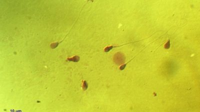 Harvard probará CRISPR en el esperma para prevenir el alzhéimer