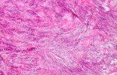 Un antiguo fármaco contra el cáncer de mama regula las células tumorales del páncreas