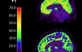 Descubren un biomarcador en el cerebro relacionado con el suicidio