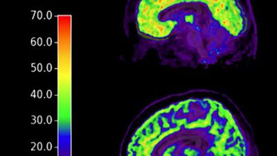Descubren un biomarcador en el cerebro relacionado con el suicidio