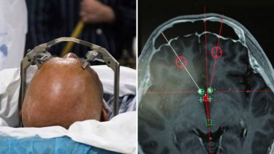 Médicos en China instalan ‘máquina de la felicidad’ en el cerebro de un paciente