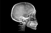 El extraño ‘bulto’ que está apareciendo en el cráneo de quienes más usan el móvil