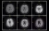 FOTO: Así se ‘devora’ el cerebro el consumo de cocaína