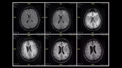 FOTO: Así se ‘devora’ el cerebro el consumo de cocaína