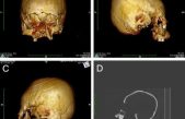 Hallan cráneos con deformación artificial de hace 1.500 años en Europa