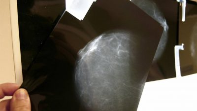 Un ‘caballo de Troya’ farmacológico optimiza la terapia contra el cáncer de mama más agresivo