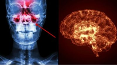 ¿Padeces de congestión nasal? Podrías tener una disminución de la conectividad cerebral