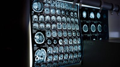 Una resonancia magnética permite ver la inflamación del cerebro ‘in vivo’ por primera vez
