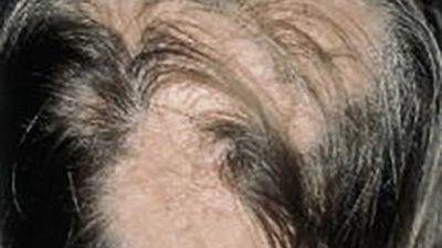 La FDA acaba de aprobar el primer fármaco sistémico que logra revertir la alopecia