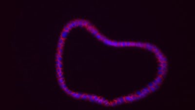 Identifican nuevos marcadores de riesgo del cáncer de colon y la colitis ulcerosa