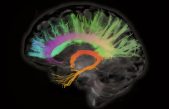 Estimulación cerebral para combatir la pérdida de memoria en la vejez
