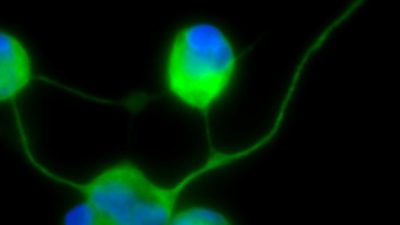 Generan neuronas mediante reprogramación directa a partir de las células de la piel de pacientes mitocondriales con el síndrome MELAS