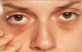 Elimina las ojeras con estos 4 remedios caseros