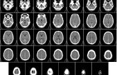 Descubren un nuevo tipo de células del cerebro humano