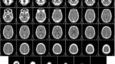 Descubren un nuevo tipo de células del cerebro humano