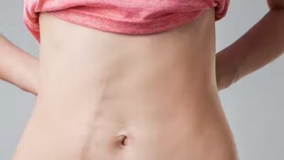 Melanina sintética: la nueva terapia para regenerar la piel y borrar cicatrices