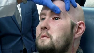 Hospital de Nueva York realiza con éxito el primer trasplante de ojo completo en la historia